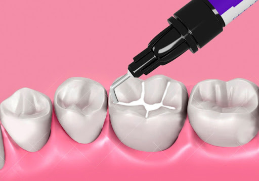 فیشورسیلانت ماده ای برای کاهش پوسیدگی دندان